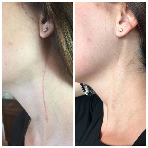 Silicon Scar Removal Stick