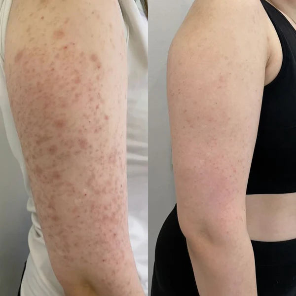 Silicon Scar Removal Stick